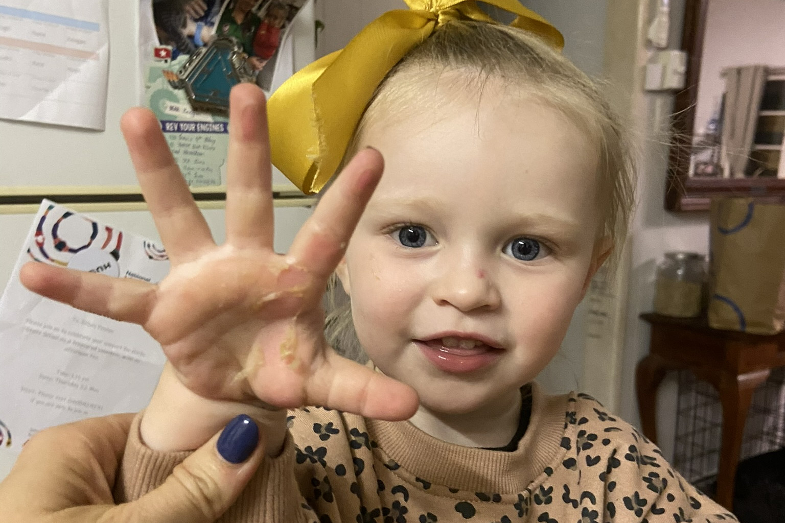 Kinsley Daniels and her nearly-healed hand three weeks aft er the burn. Photo supplied.